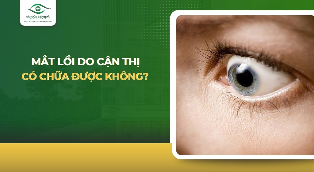 Mắt lồi do cận