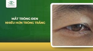 Mắt tròng đen nhiều hơn tròng trắng