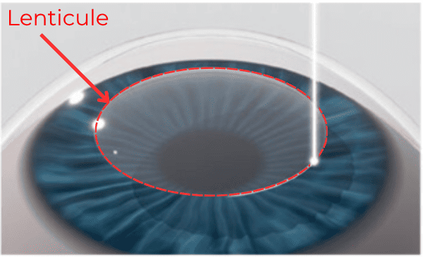 Mổ cận CLEAR - bước 1