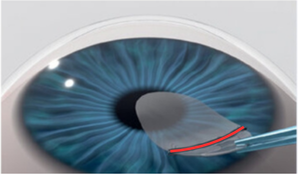 Mổ cận CLEAR bước 2