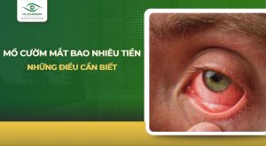 mổ cườm mắt bao nhiêu tiền