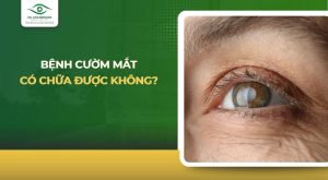 Bệnh cườm mắt có chữa được không?