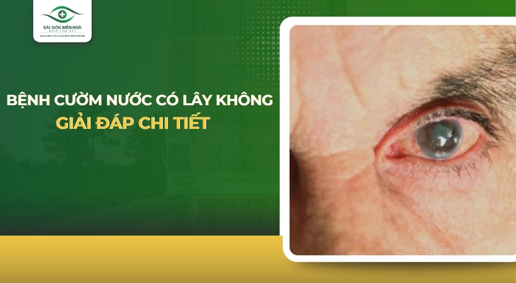 Bệnh cườm nước có lây không