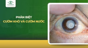 cườm khô và cườm nước