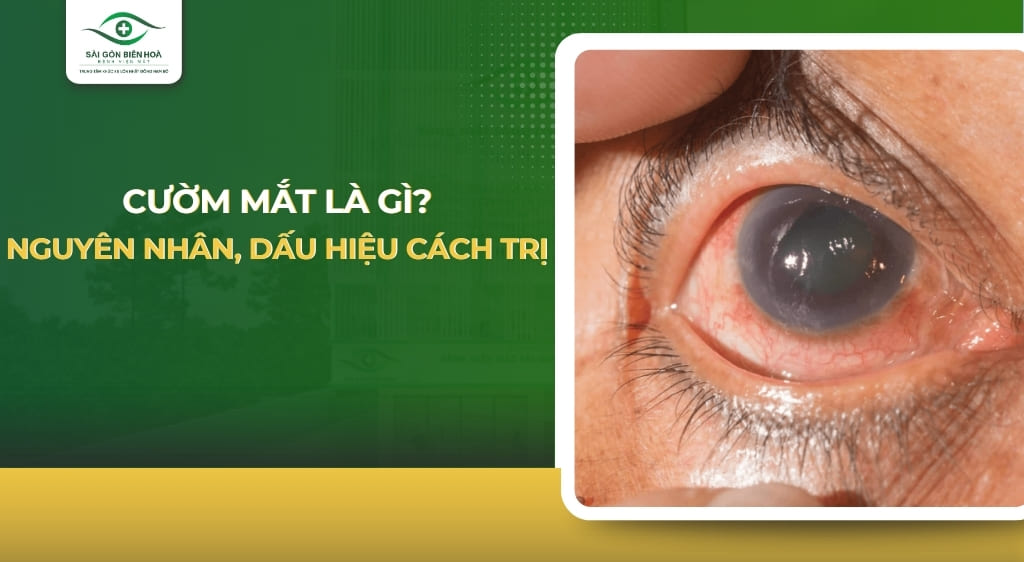Cườm mắt là gì