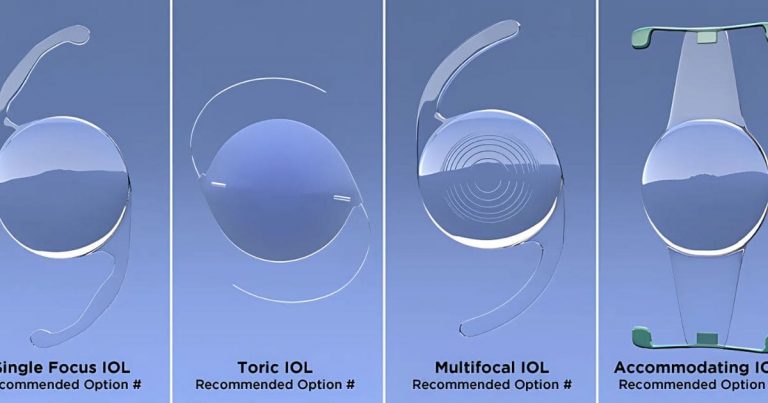 IOL là gì? Cấu tạo, Quy trình, Hướng dẫn chọn IOL phù hợp