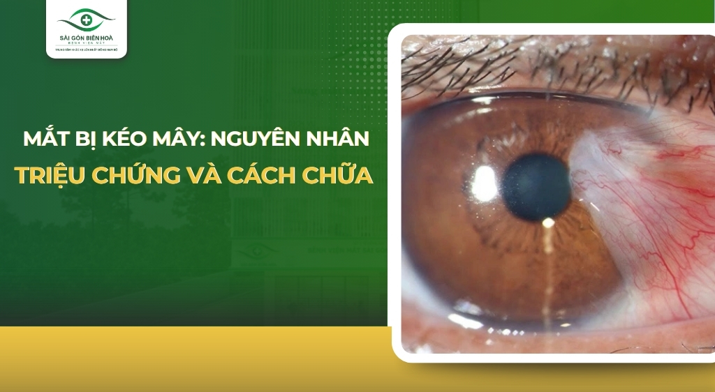mắt bị kéo mây