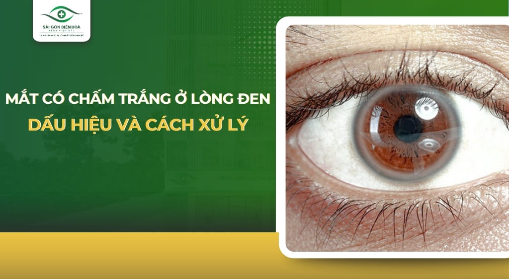 mắt có chấm trắng ở lòng đen