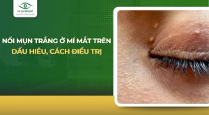 Nổi mụn trắng ở mí mắt trên