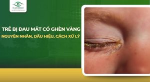 Trẻ bị đau mắt có ghèn vàng