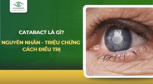 Cataract là gì