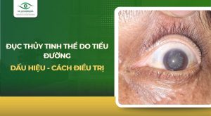 Đục thủy tinh thể do tiểu đường