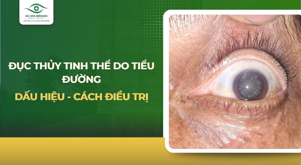 Đục thủy tinh thể do tiểu đường