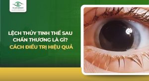 Lệch thủy tinh thể sau chấn thương