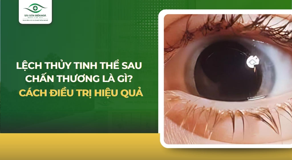 Lệch thủy tinh thể sau chấn thương