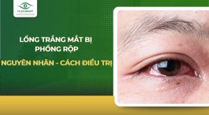 Lòng trắng mắt bị phồng rộp