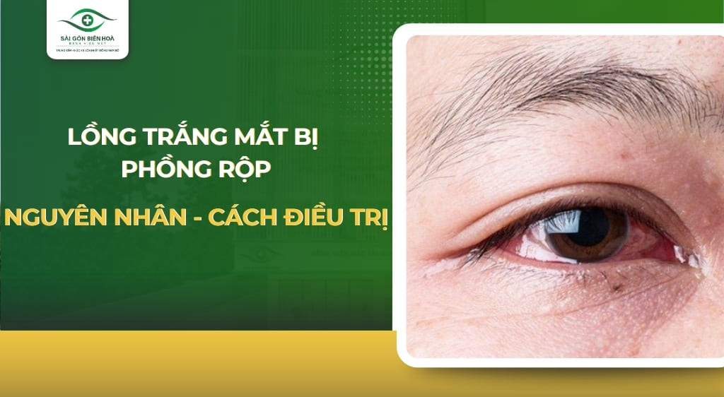Lòng trắng mắt bị phồng rộp