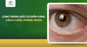 lòng trắng mắt có đốm vàng