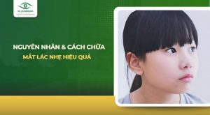 Mắt lác nhẹ