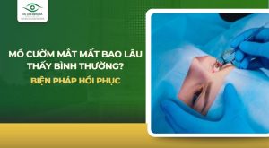 Mổ cườm mắt mất bao lâu