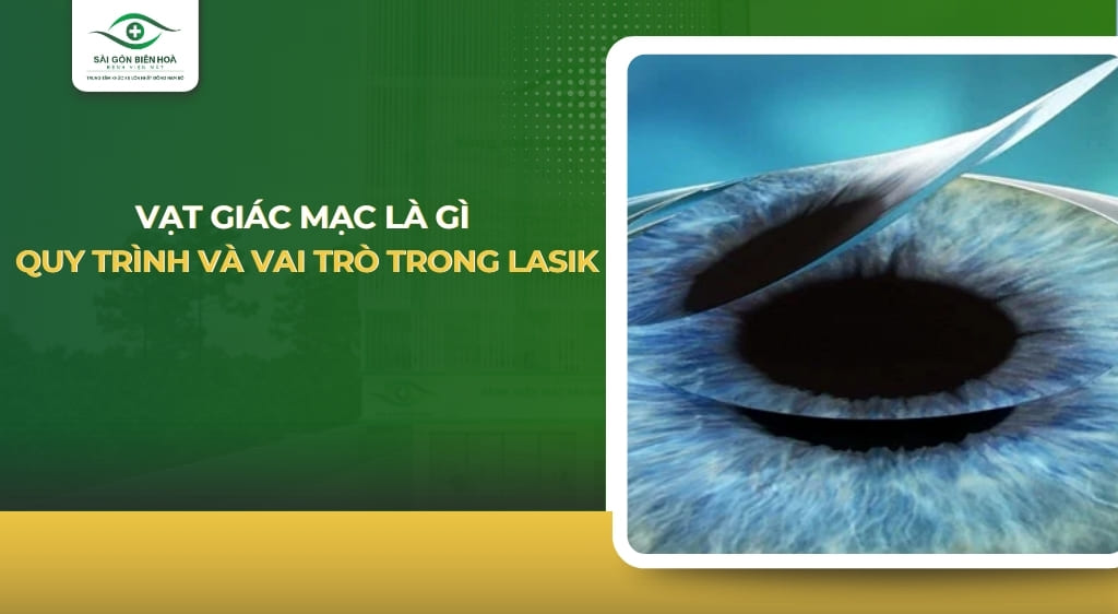 Vạt giác mạc là gì