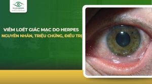 Viêm loét giác mạc do herpes