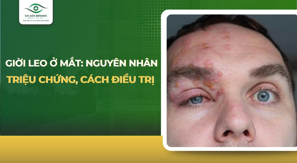 giời leo ở mắt