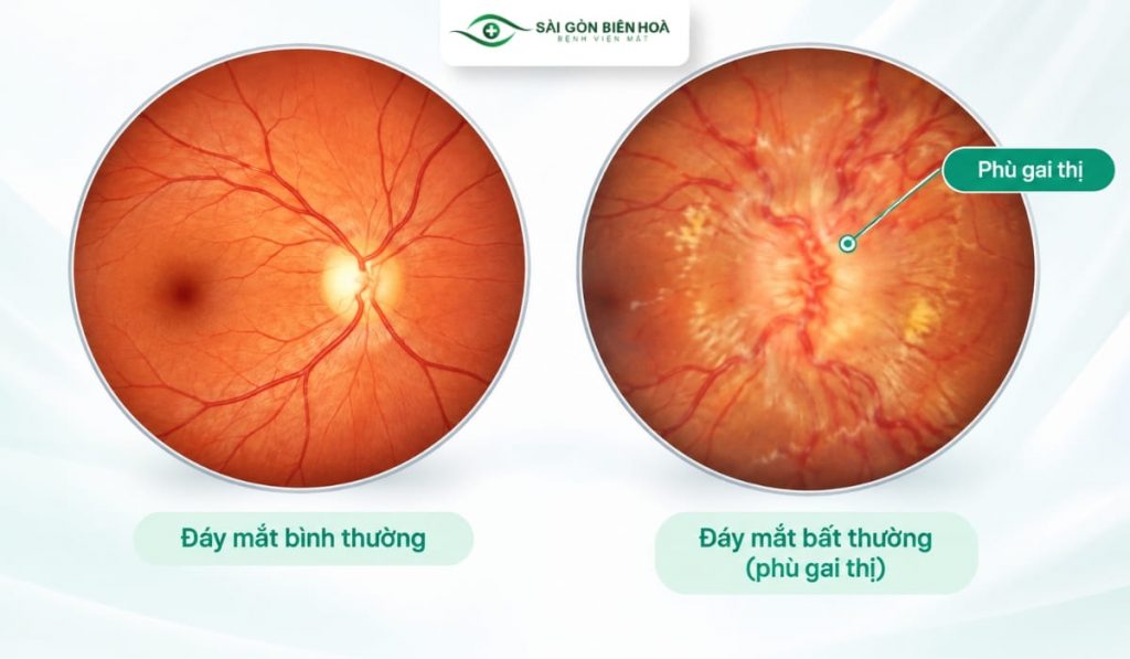 Hình ảnh soi đáy mắt bất thường phù gai thị