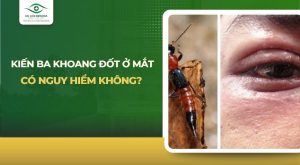 kiến ba khoang đốt ở mắt