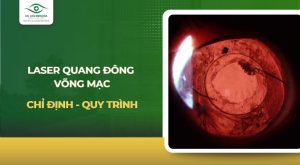 Laser quang đông võng mạc