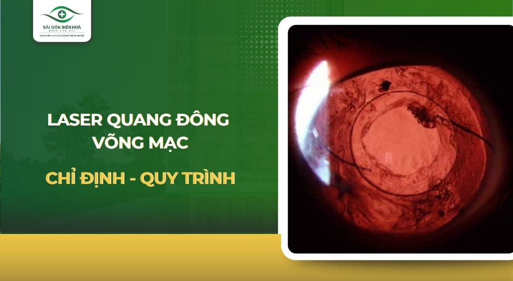 Laser quang đông võng mạc
