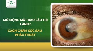 Mổ mộng mắt bao lâu thì lành