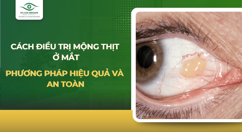 cách điều trị mộng thịt ở mắt