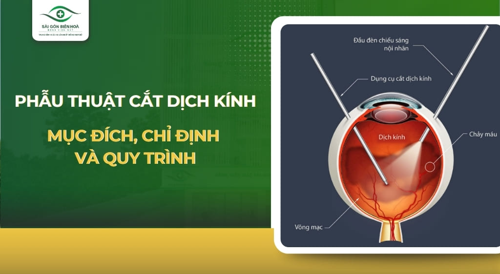 phẫu thuật cắt dịch kính