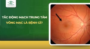 tắc động mạch trung tâm võng mạc