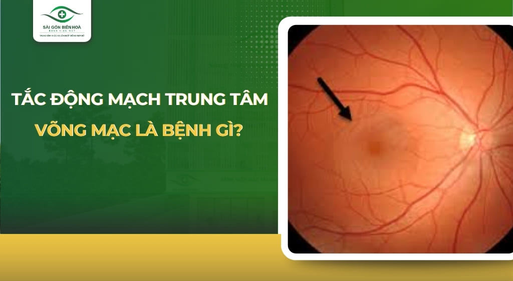 tắc động mạch trung tâm võng mạc