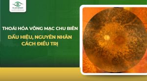 thoái hóa võng mạc chu biên