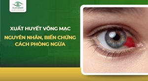 xuất huyết võng mạc