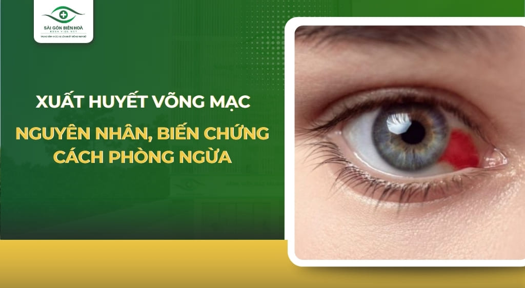 xuất huyết võng mạc