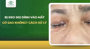 bị keo 502 dính vào mắt