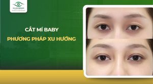 cắt mí baby