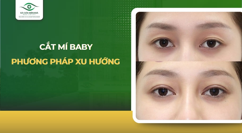 cắt mí baby