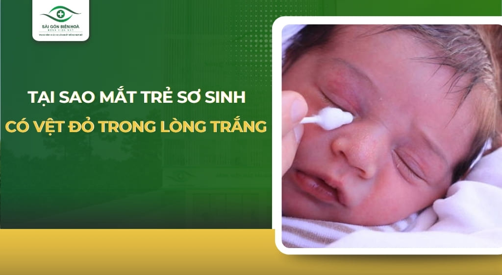 mắt trẻ sơ sinh có vệt đỏ