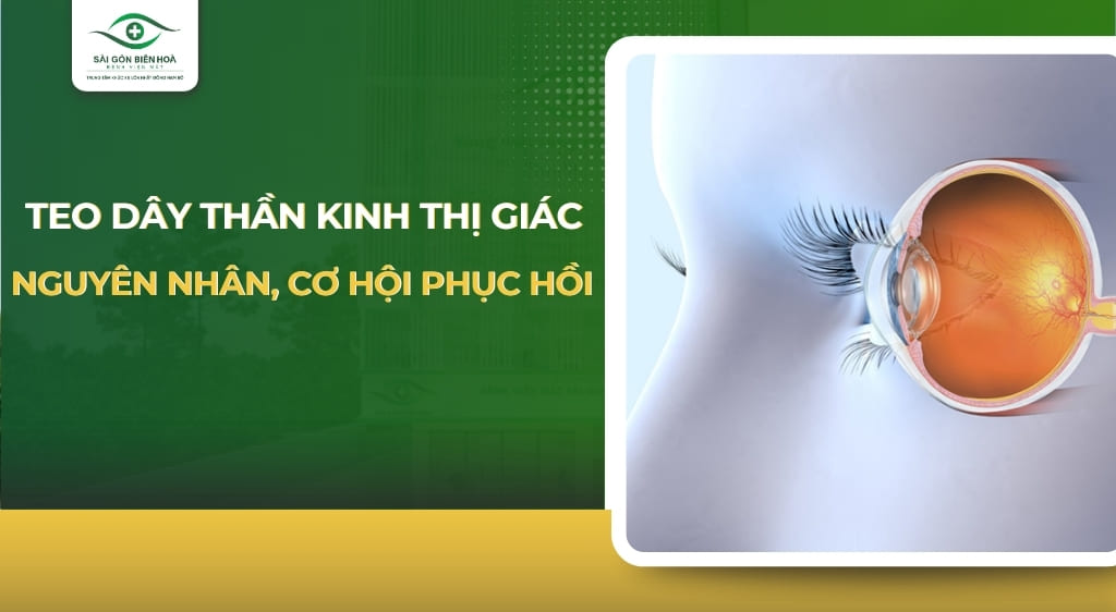 teo dây thần kinh thị giác