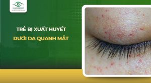 trẻ bị xuất huyết dưới da quanh mắt