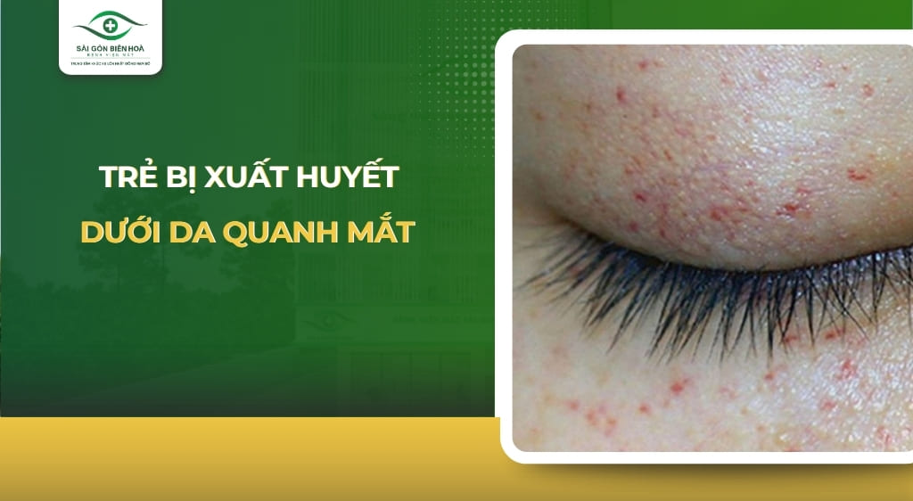 trẻ bị xuất huyết dưới da quanh mắt
