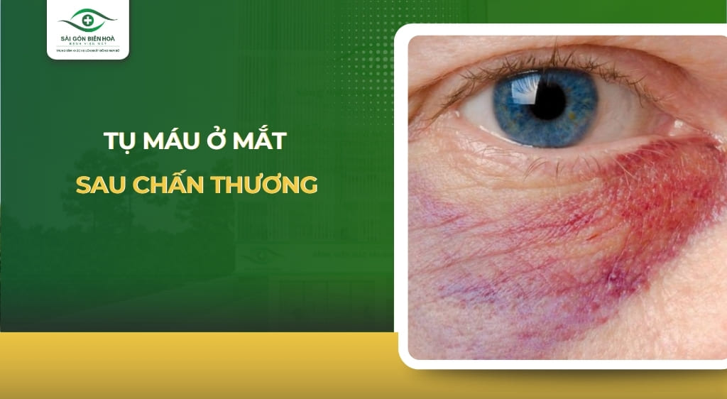 tụ máu ở mắt sau chấn thương