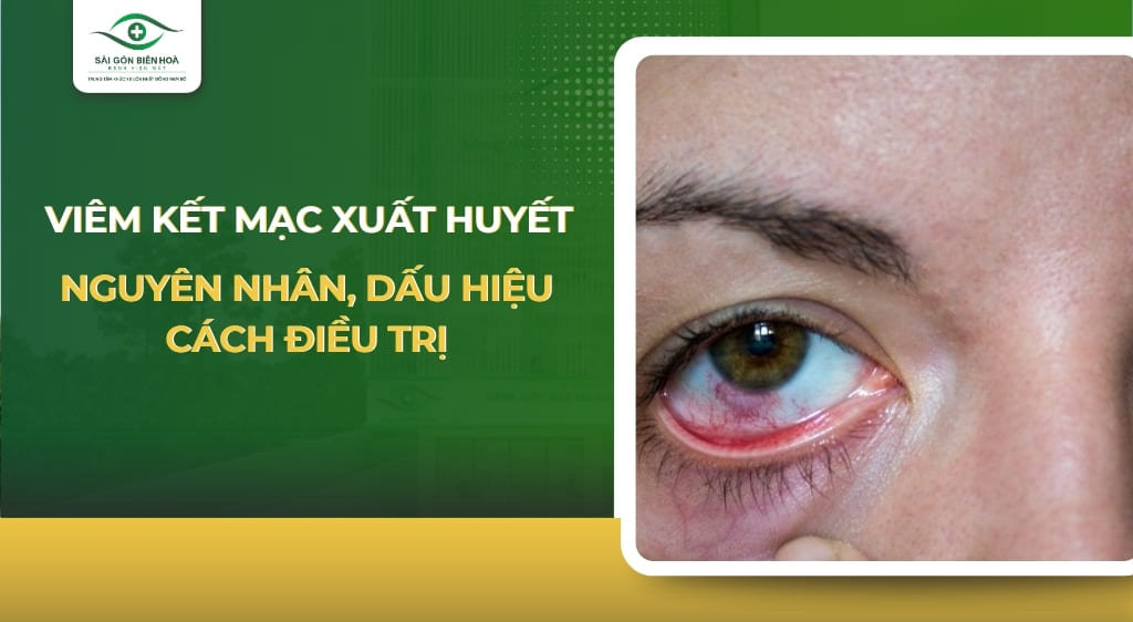 viêm kết mạc xuất huyết