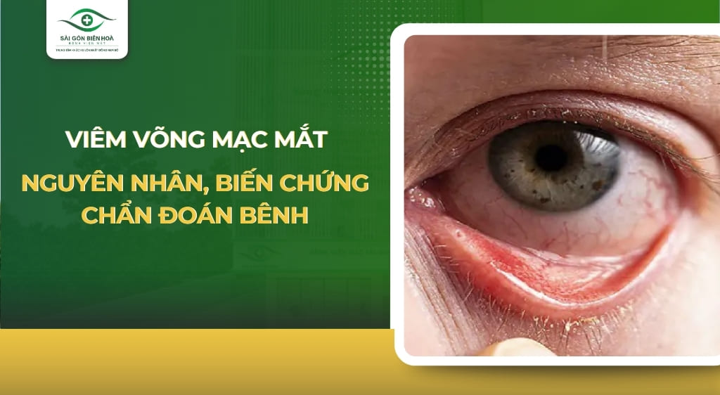 viêm võng mạc