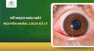 vỡ mạch máu mắt
